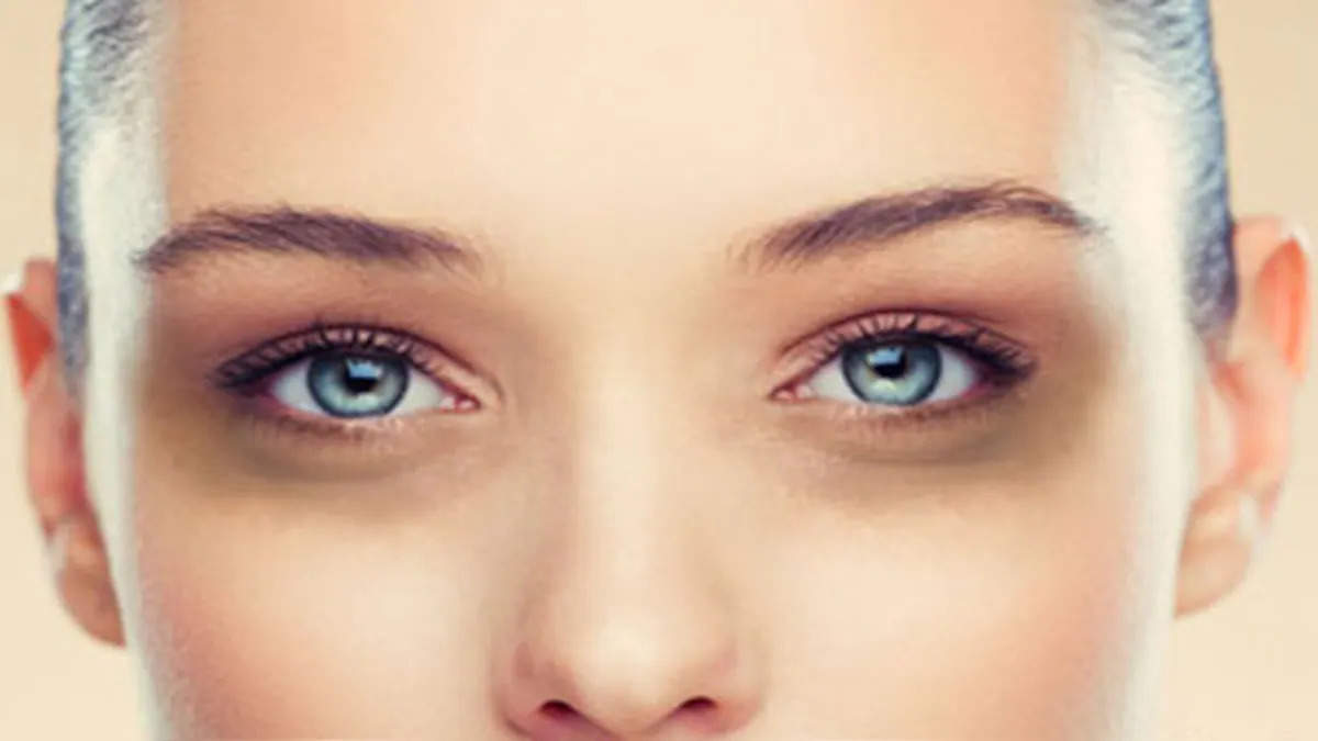 Skin care Tips- आंखो के नीचे काले घेरे हैं, दूर करने के लिए अपनाएं ये आसान उपाय