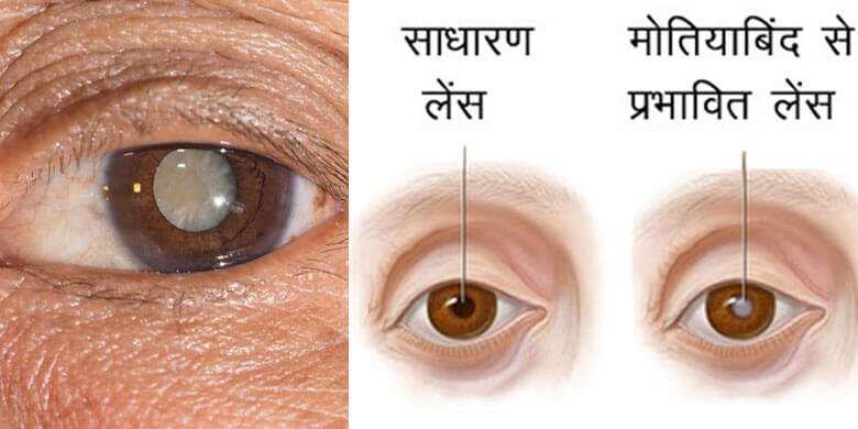 मोतियाबिंद