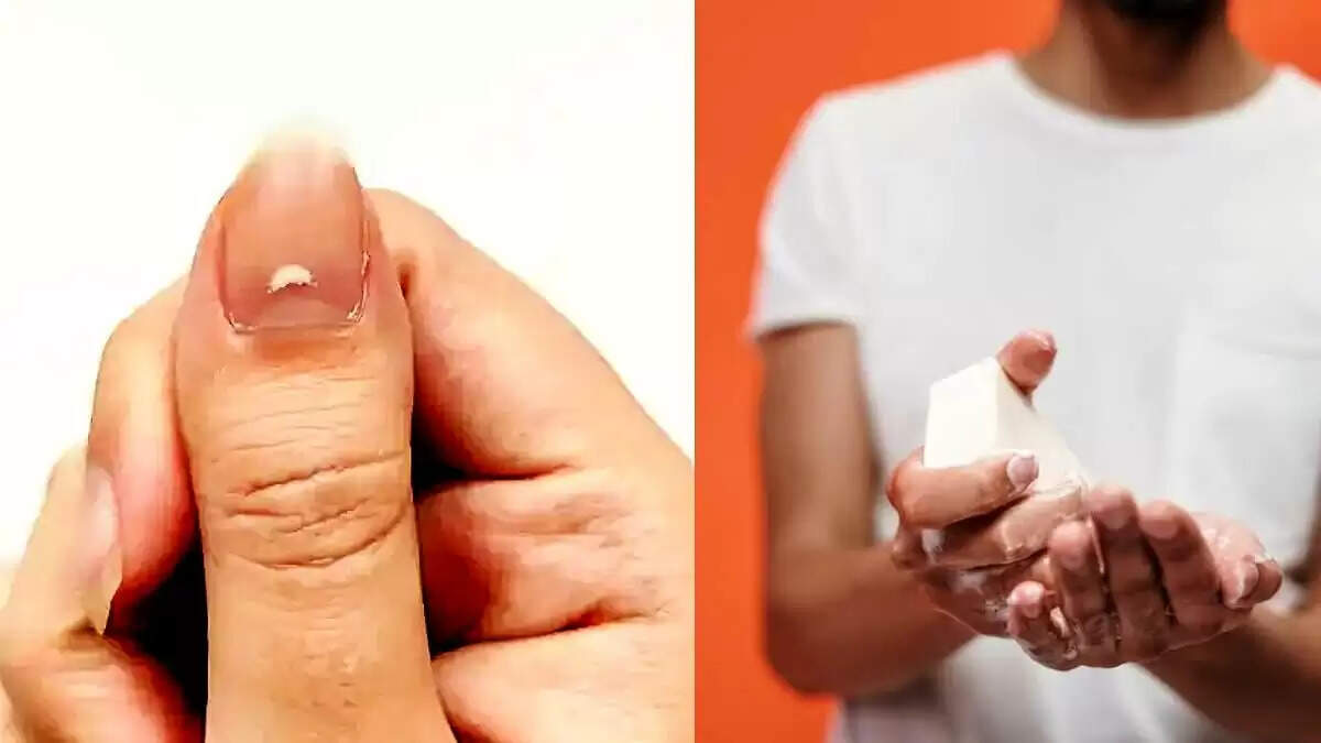 Health Tips –नाखूनों में हो रहे हैं सफेद धब्बे, तो हो जाएं सावधान