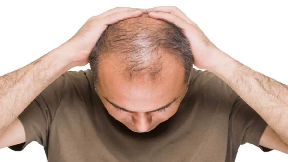 Hair Care Tips- आहार में इन चीजों के खाने से हो सकती हैं गंजेपन की समस्या, जानिए इनके बारें में