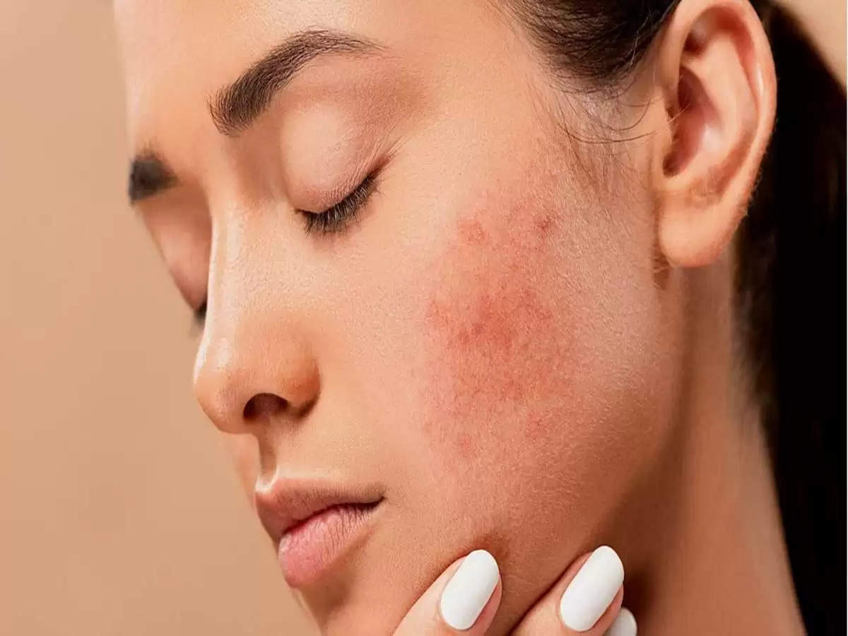 Skin Care Tips- महांसे क्यों होते हैं और इनके कितने प्रकार हैं, आइए जानते है