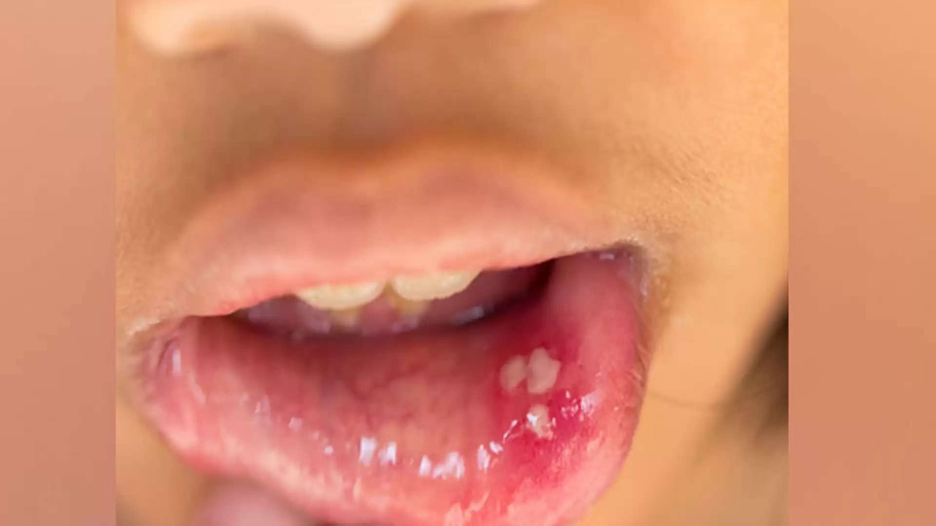 Health Tips- क्या मुंह में हो रहे हैं सफेद छाले, ना करें नजरअदांज, हो सकती हैं बड़ी बीमारी